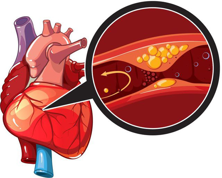 Phòng Ngừa Tăng Mỡ Máu Bằng 3 Thay Đổi Đơn Giản Này