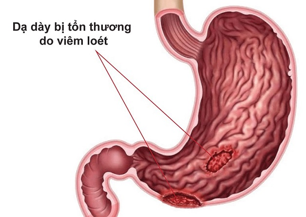 3 điều cần biết về viêm loét dạ dày