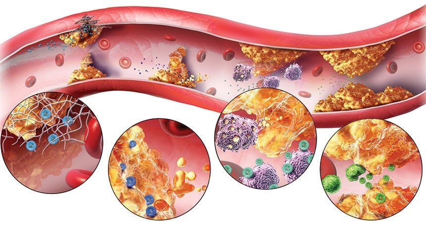 Rối loạn mỡ máu gây ra 7 biến chứng nguy hiểm