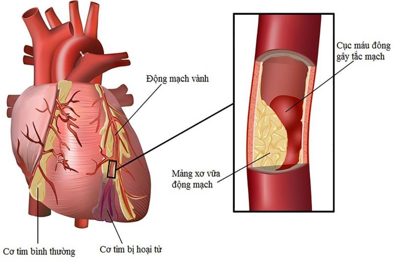 Nhồi máu cơ tim là gì? - 3 điều cần biết về nhồi máu cơ tim